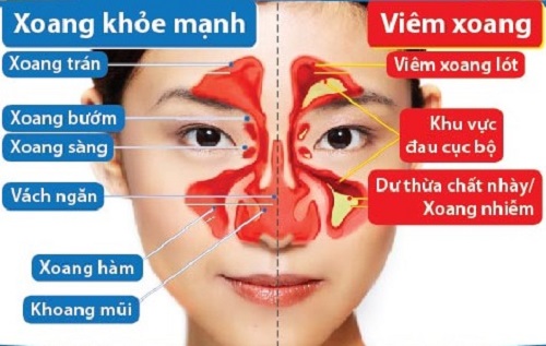 Cách phòng ngừa viêm amidan tại nhà