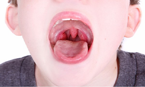 Bệnh viêm họng biến chứng nguy hiểm.